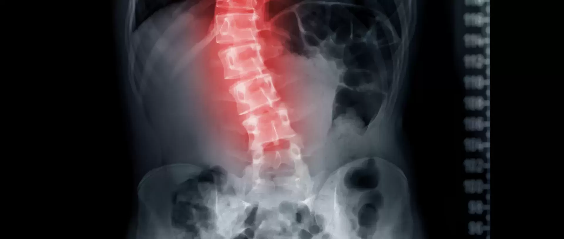 Finding Relief from Scoliosis Through Rolfing®