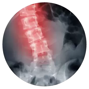 Finding Relief from Scoliosis Through Rolfing®